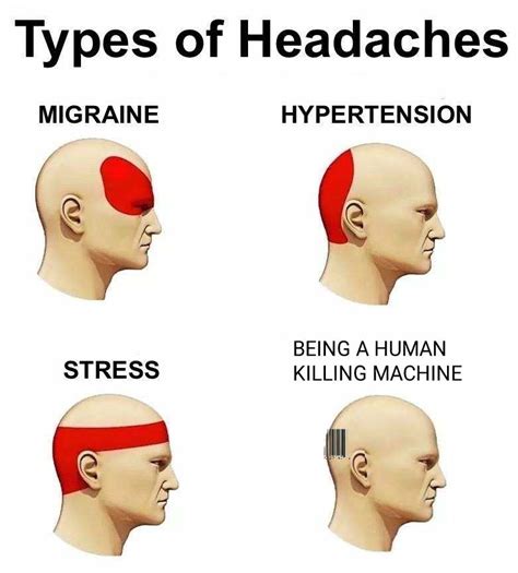 headache location diagram 